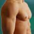 Effective-Gynecomastia-Surgery-in-India-Things-to-Know